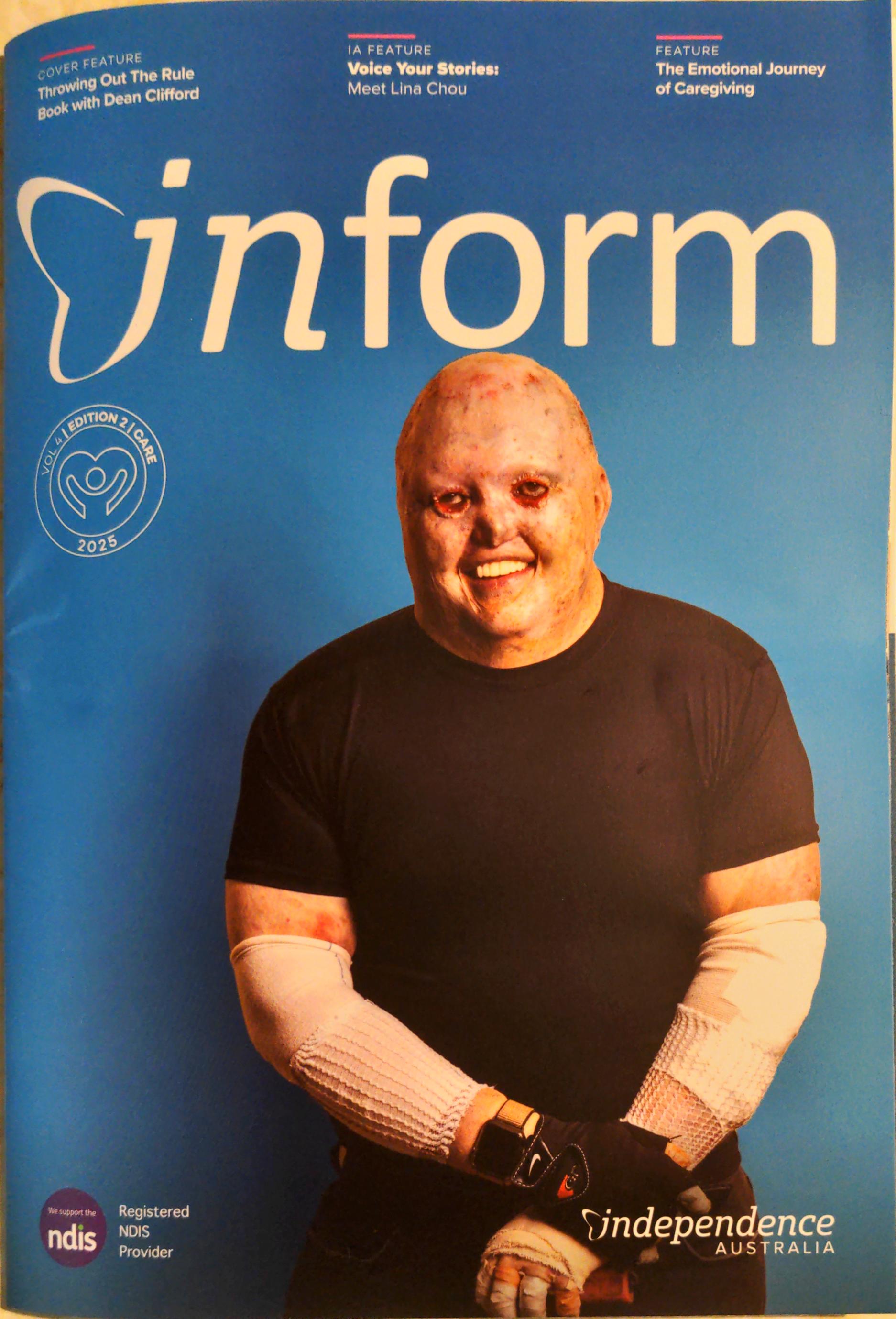 Burn survivor smiling